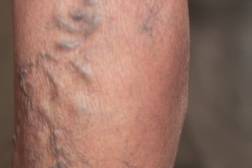 Raised, rope-like varicose veins on a lower leg