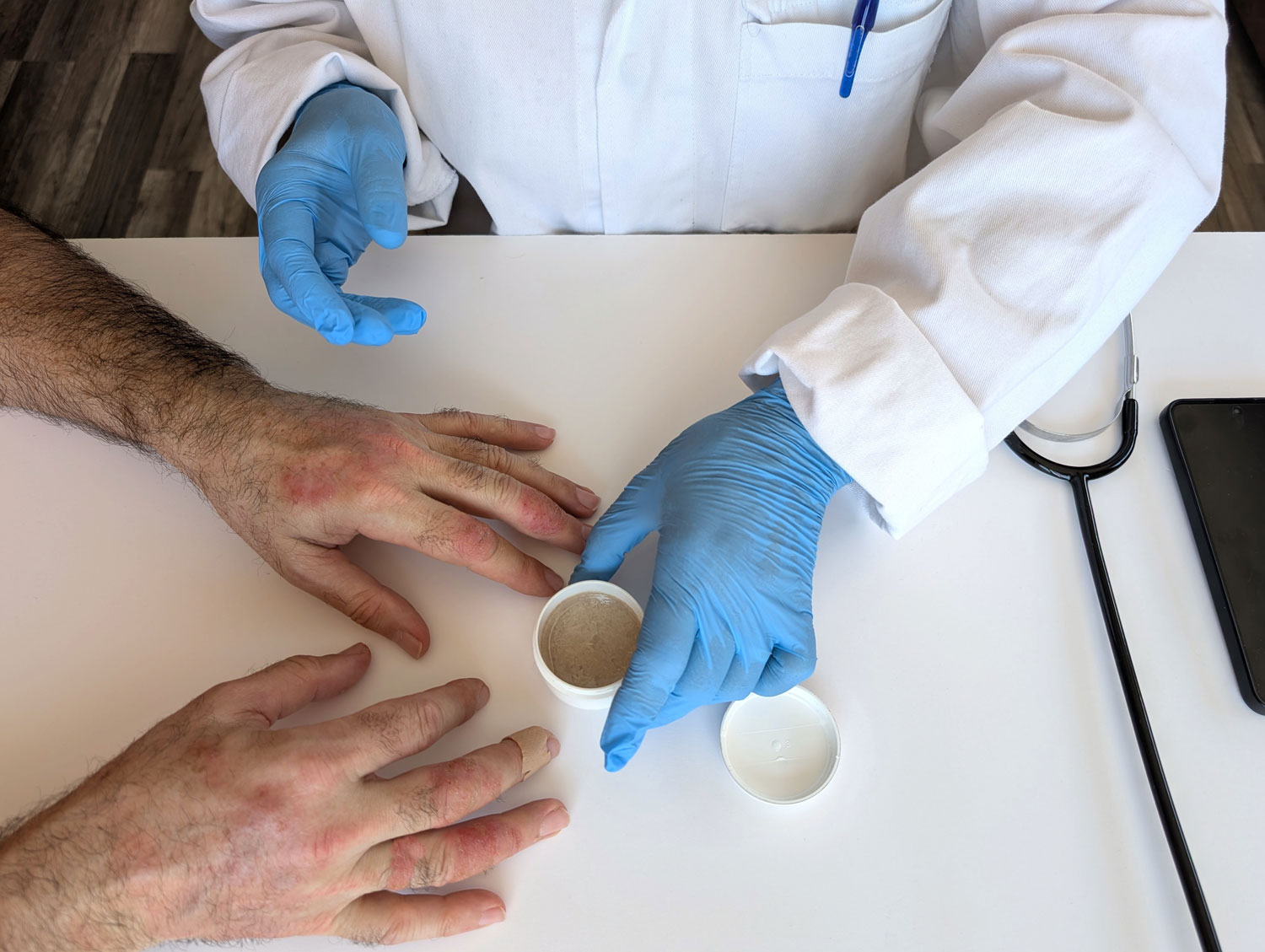 Dermatologist applying treatment to eczema-affected hands