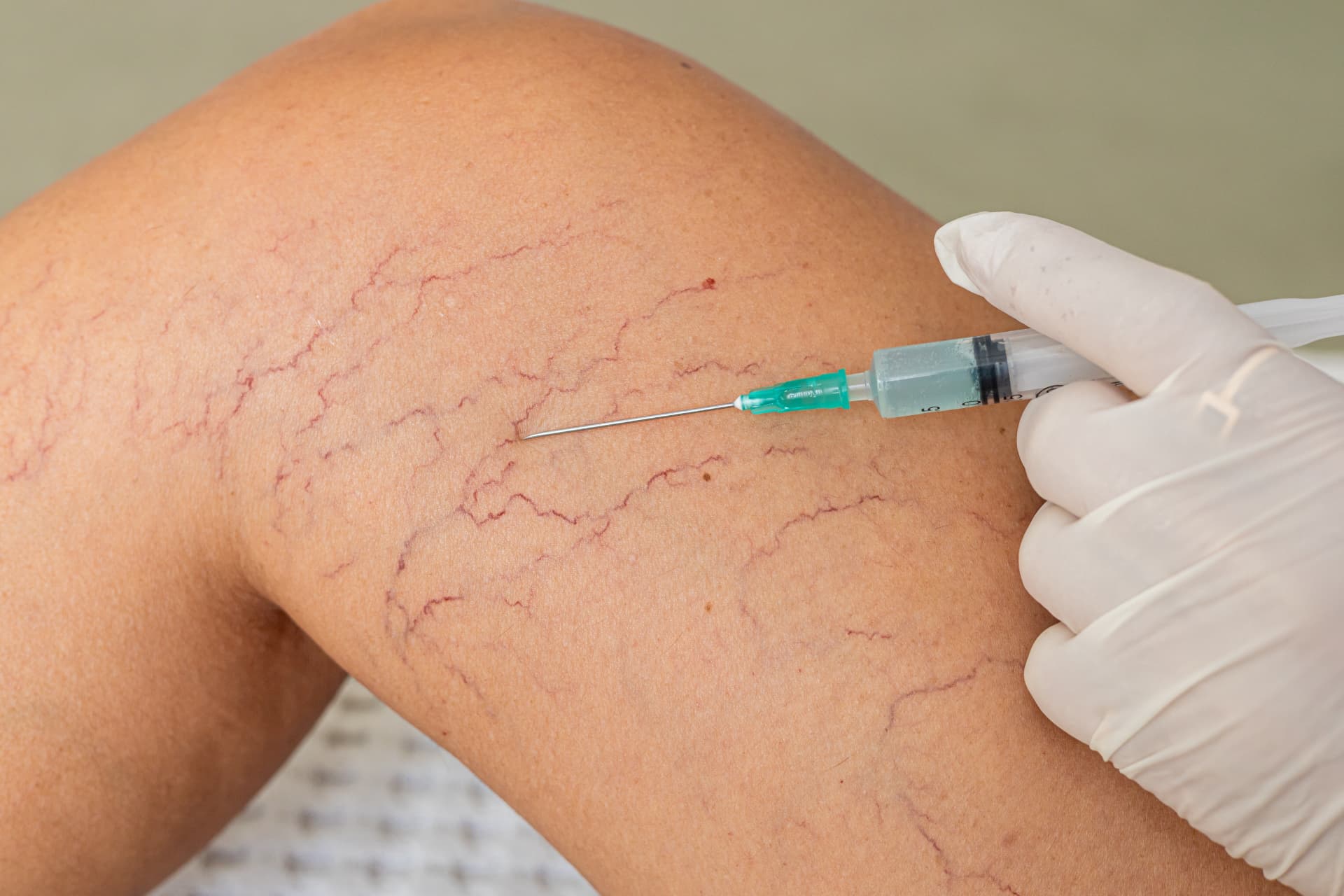 Clinician treating spider veins on a leg with an injection