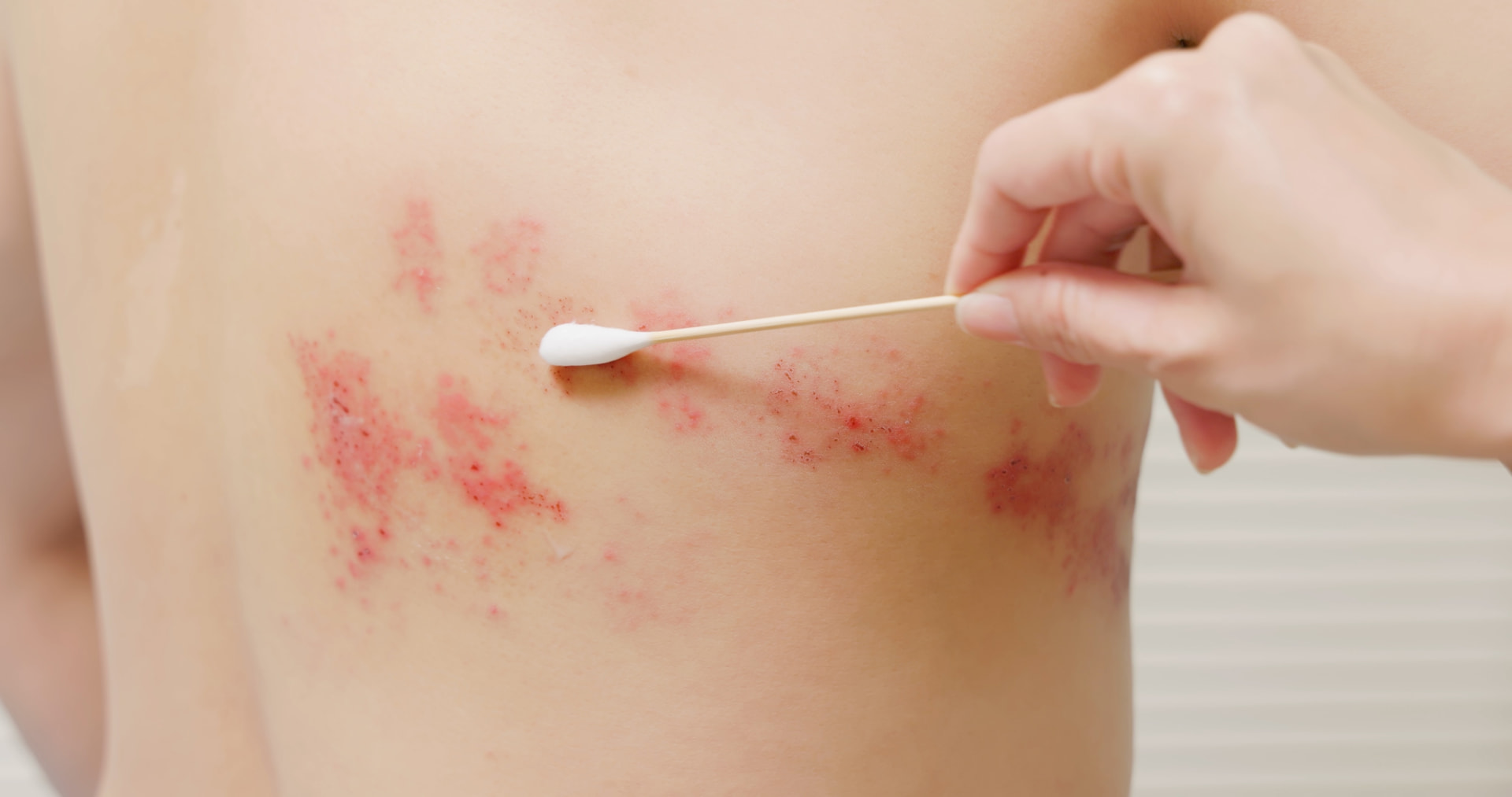 Clinician examining a shingles rash on a patient's back