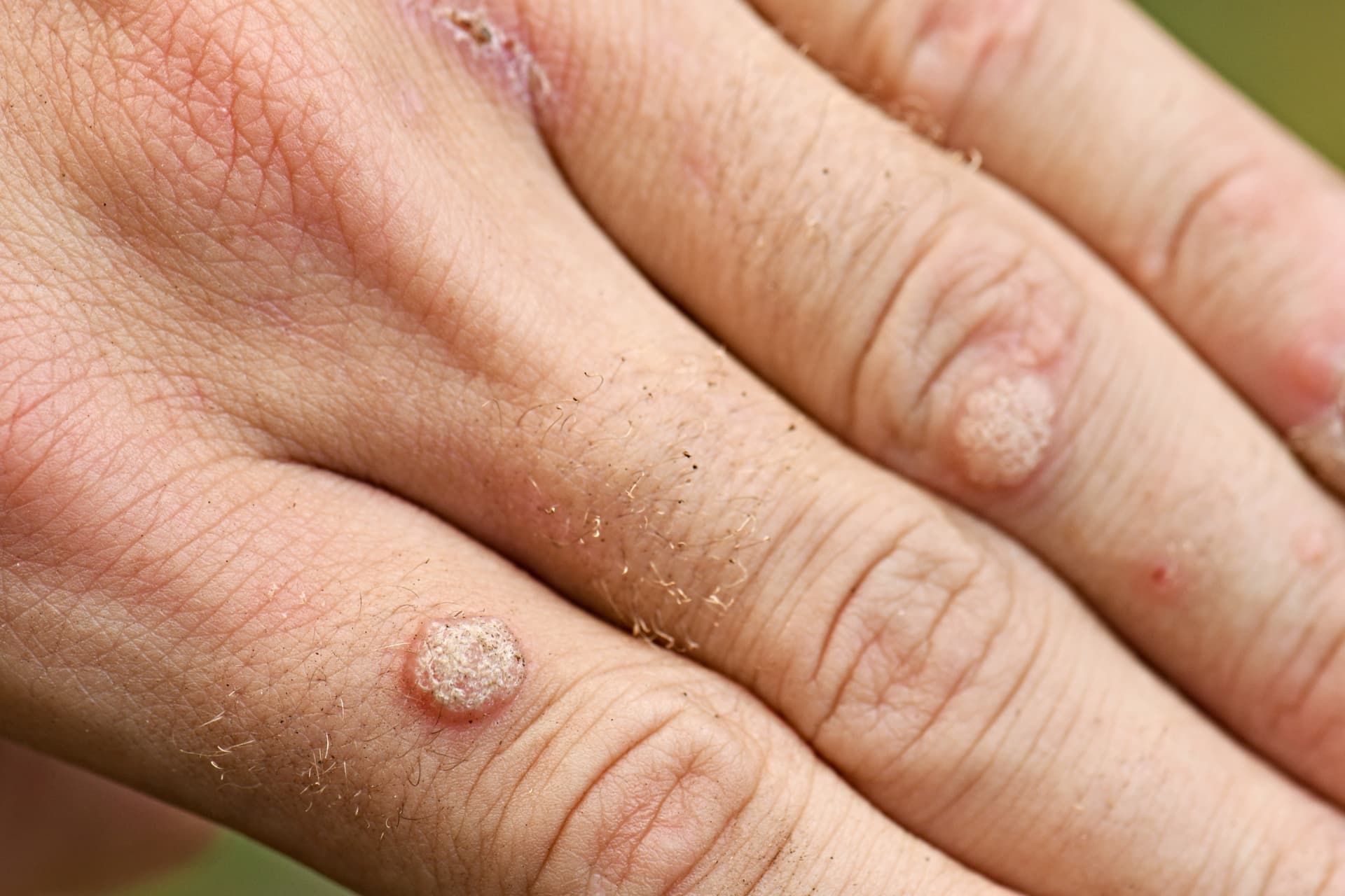 Close-up of common warts on the knuckles of a hand