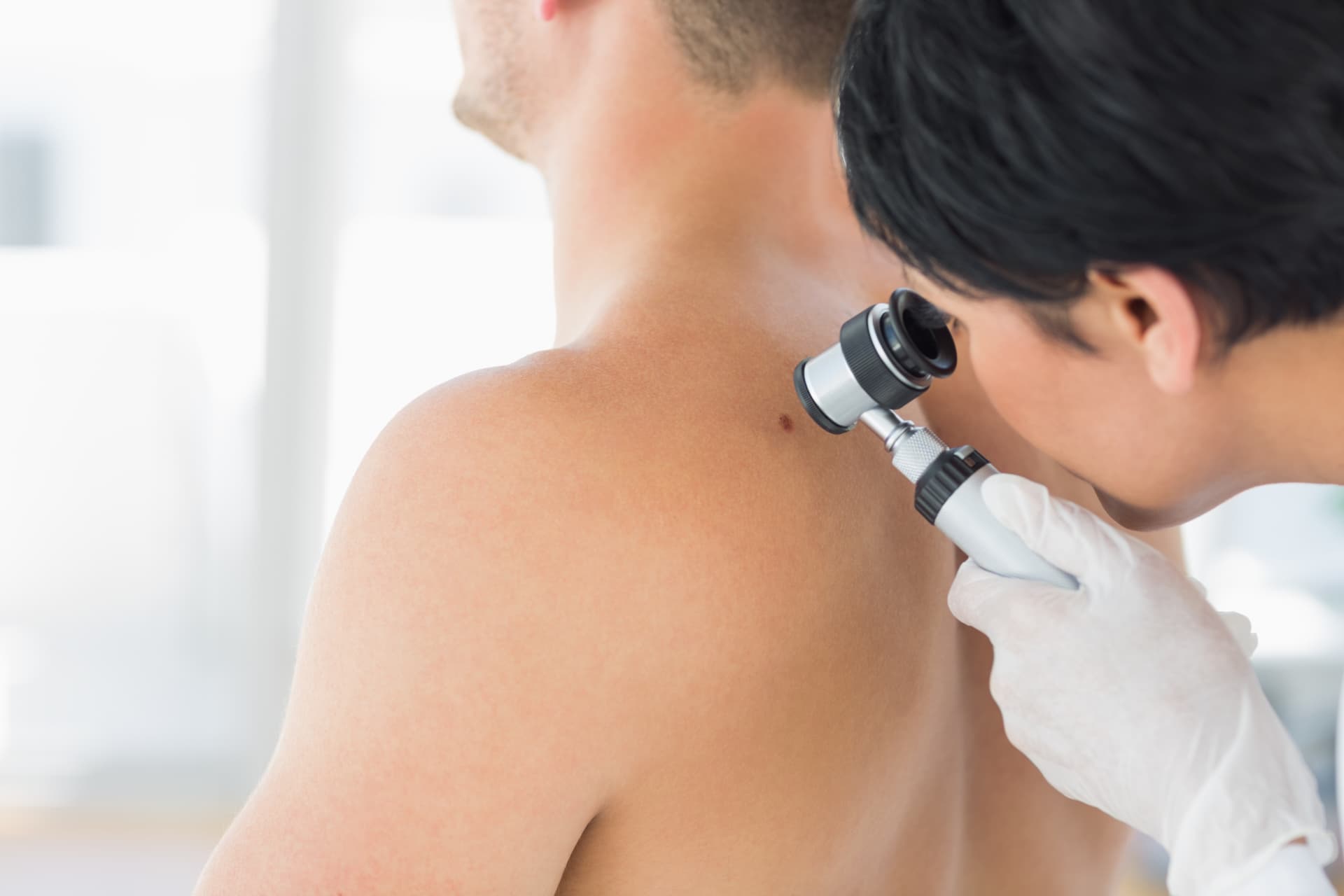 Dermatologist examining a mole on a patient's shoulder with a dermatoscope