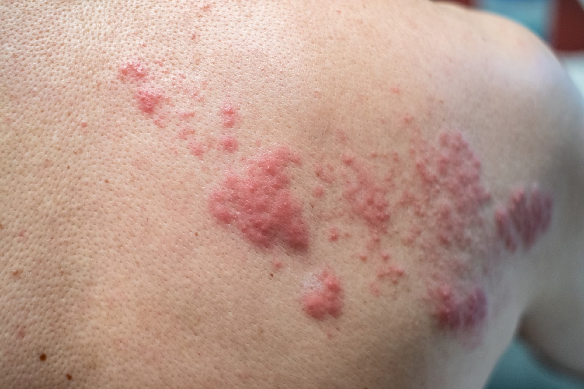 Close-up of a shingles rash on the back