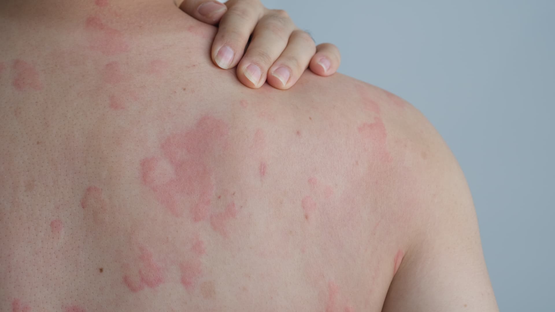 Hives on a person's back and shoulder