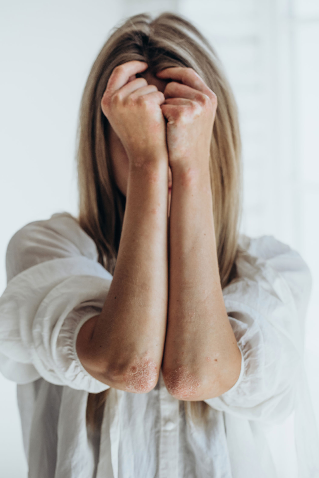 Woman with psoriasis covering her elbows and arms