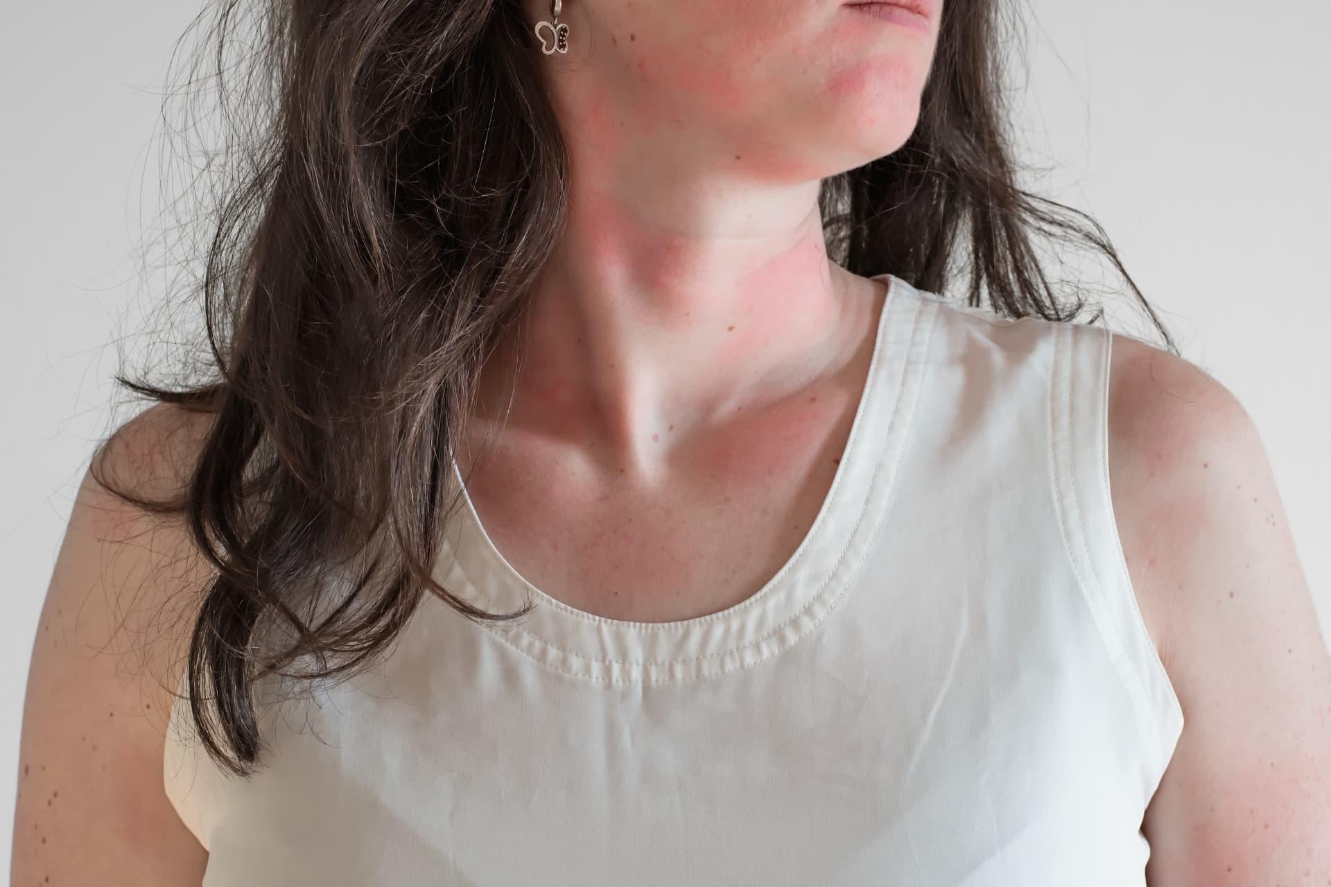 Woman with red hives on her neck and chest