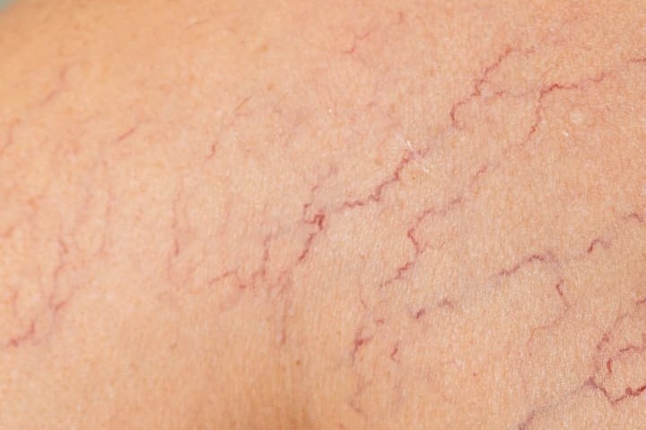 Close-up of fine red spider veins at the skin's surface