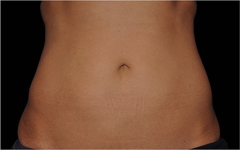 Abdomen treated with CoolSculpting, after treatment