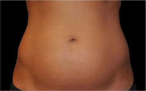 Abdomen treated with CoolSculpting, before treatment