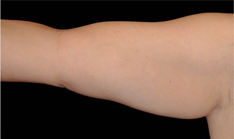 Upper arm treated with CoolSculpting, after treatment