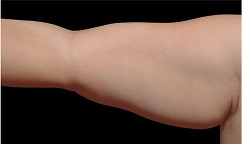 Upper arm treated with CoolSculpting, before treatment