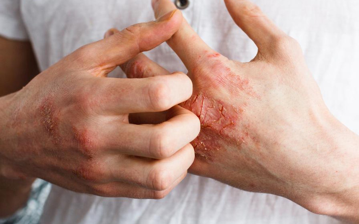 Close-up of eczema-affected skin on the hand during winter
