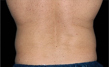 Flanks treated with CoolSculpting, after treatment