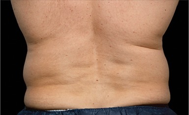 Flanks treated with CoolSculpting, before treatment