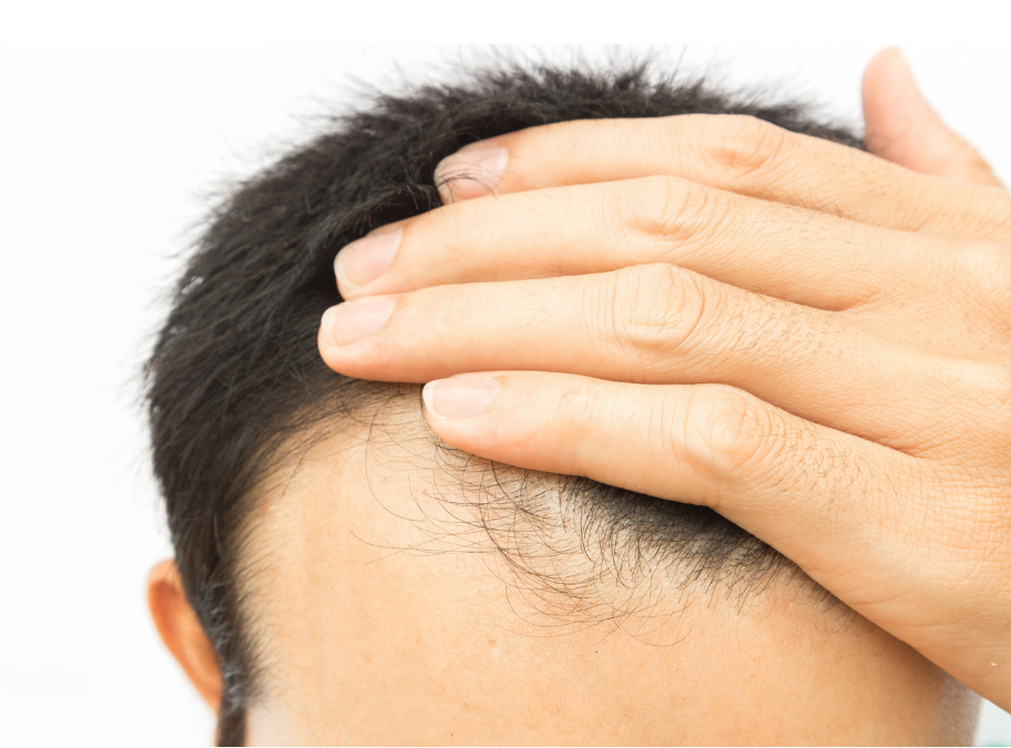 Hair loss occurs in both men and women