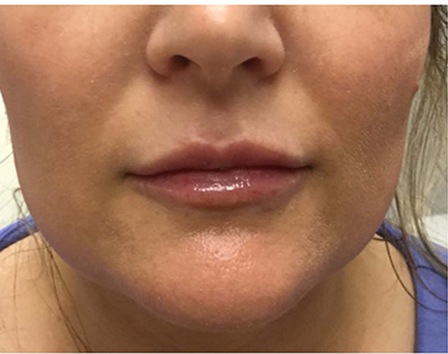 Lips treated with Juvéderm hyaluronic acid filler, after treatment