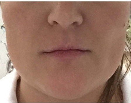Lips treated with Juvéderm hyaluronic acid filler, before treatment